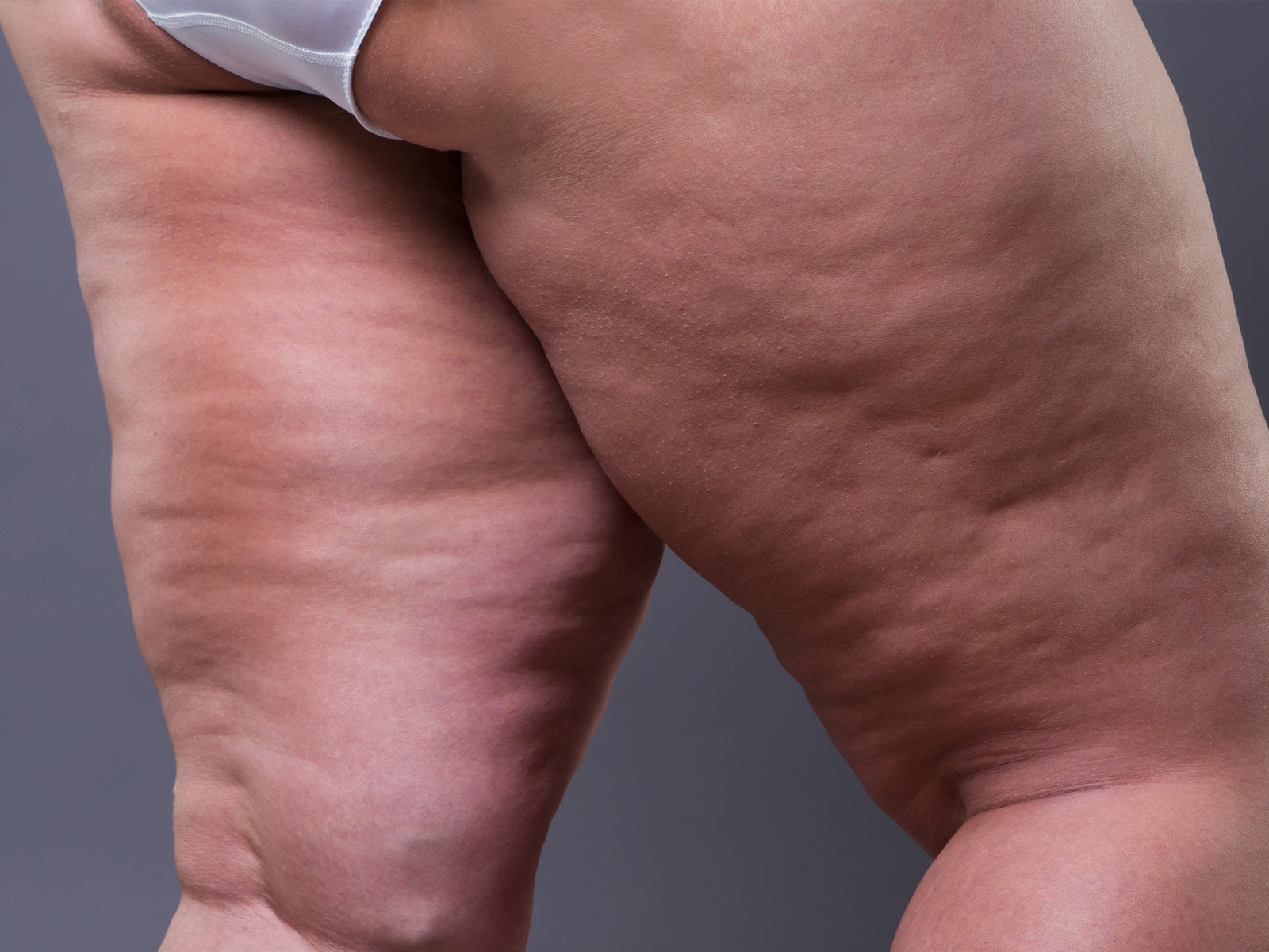 Sandheden om cellulite: Lad os få et indblik i ødematofibrosklerotisk pannikulopati