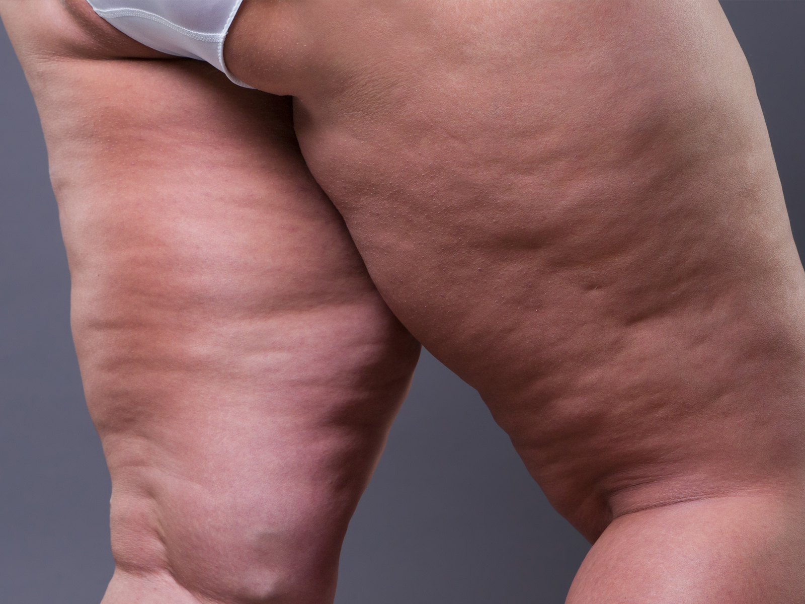 The truth about cellulite: let's gain an insight into Edematofibrosclerotic Panniculopathy